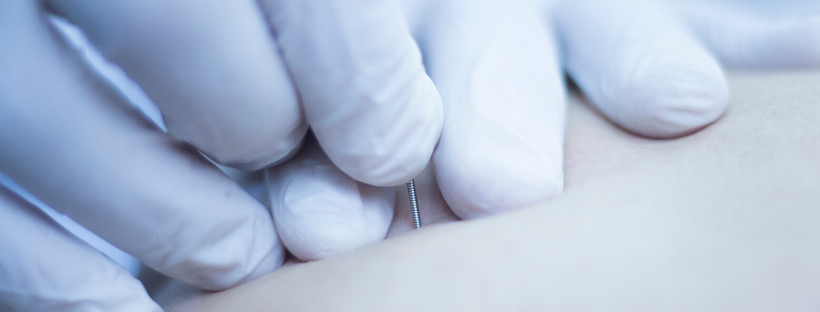 closeup of acupuncture being administered
